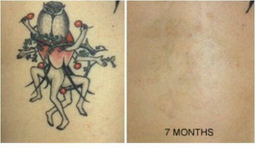 Permanent Tattoo Removal Cream