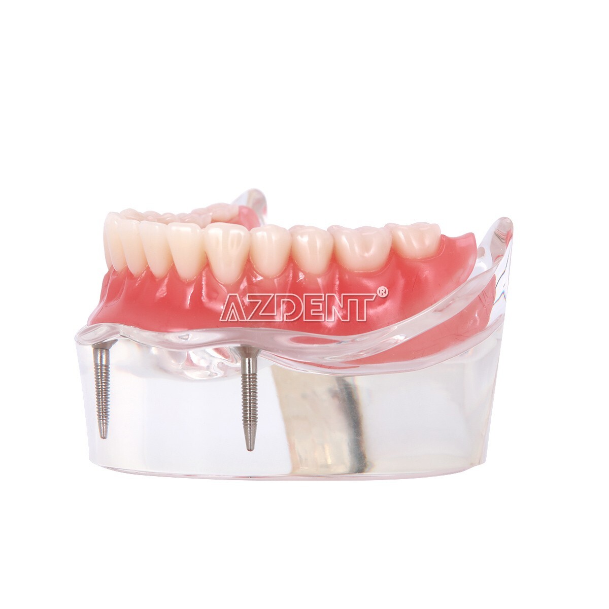 Dental Implant Teeth Model Demo Overdenture Restoration With Implants Lower