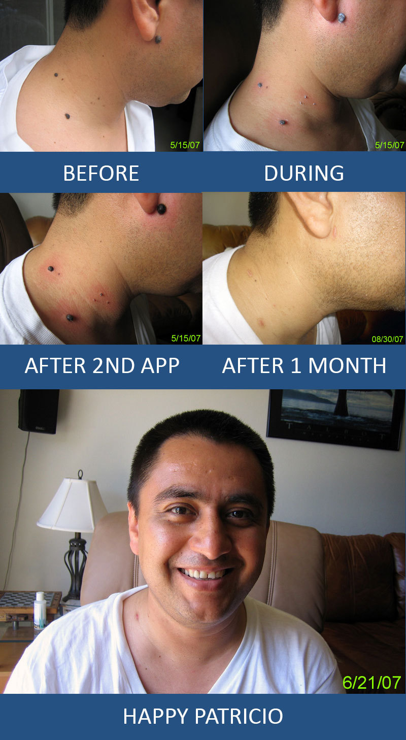 Mole Remover, Wart Remover, Skin Tag remover, Wart Mole Vanish™ Award Winning