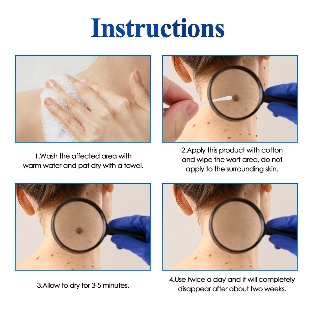 Wart Remover Liquid Skin Tag Mole Remover Eliminate Feet Corn Wart Remove Liquid