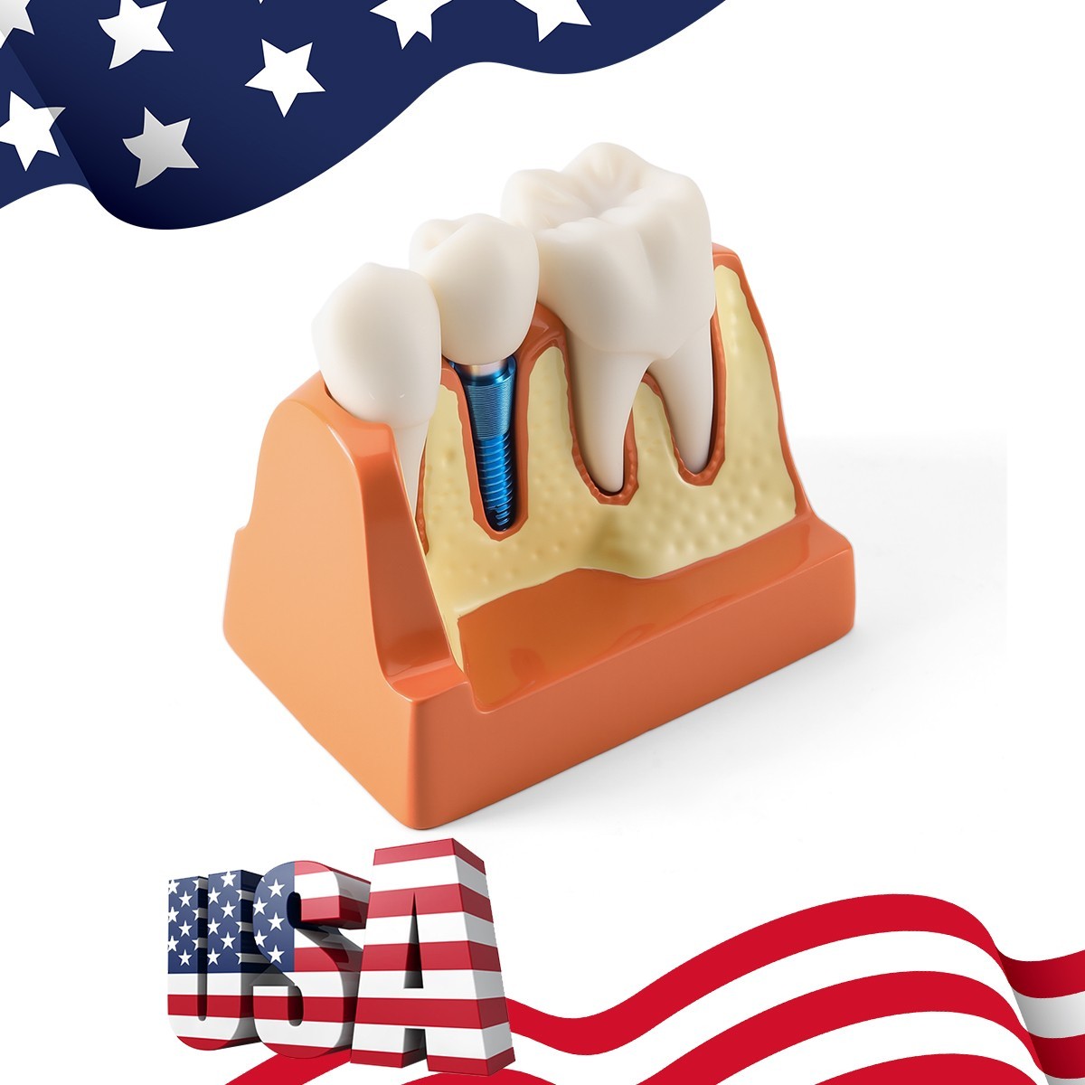Dental 4 Times Teeth Model Implant Analysis Crown Bridge Demonstration Removable