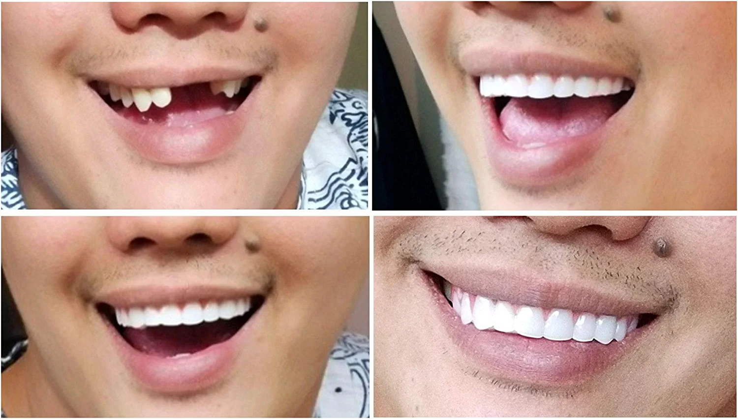 Instant Smile Comfort Fit Flex - Bright White - Upper Veneer Cosmetic Teeth