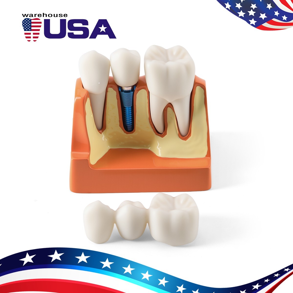 Dental 4 Times Teeth Model Implant Analysis Crown Bridge Demonstration Removable