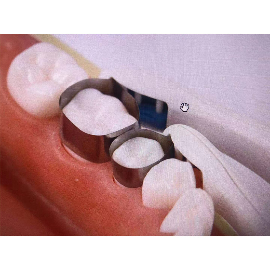 50pcs Dental Pro Matrix Bands Molar Premolar Band Stainless Steel Adjust 4.5/6MM