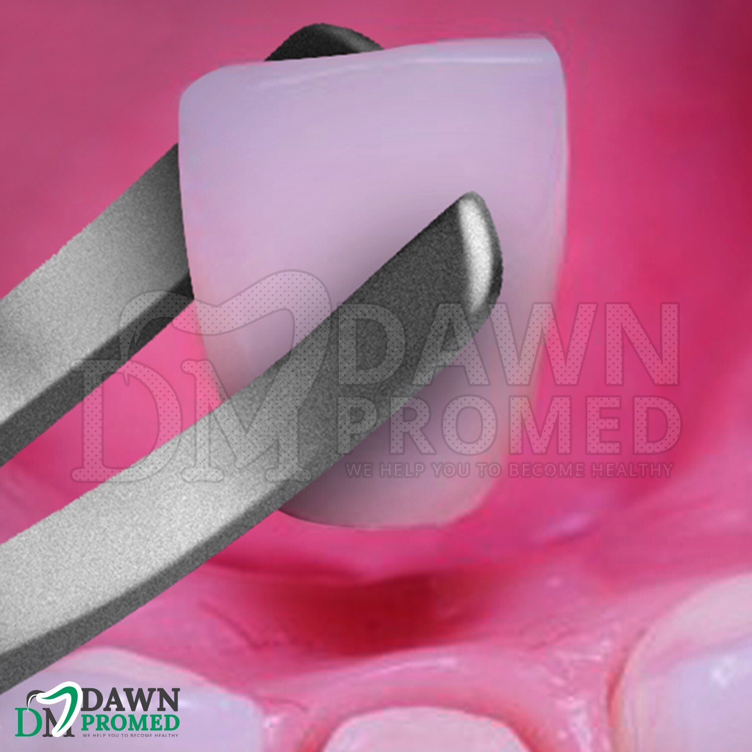 TC Wynman Crown Remover & Gripper Forceps 7" Dental Instrument German Grade