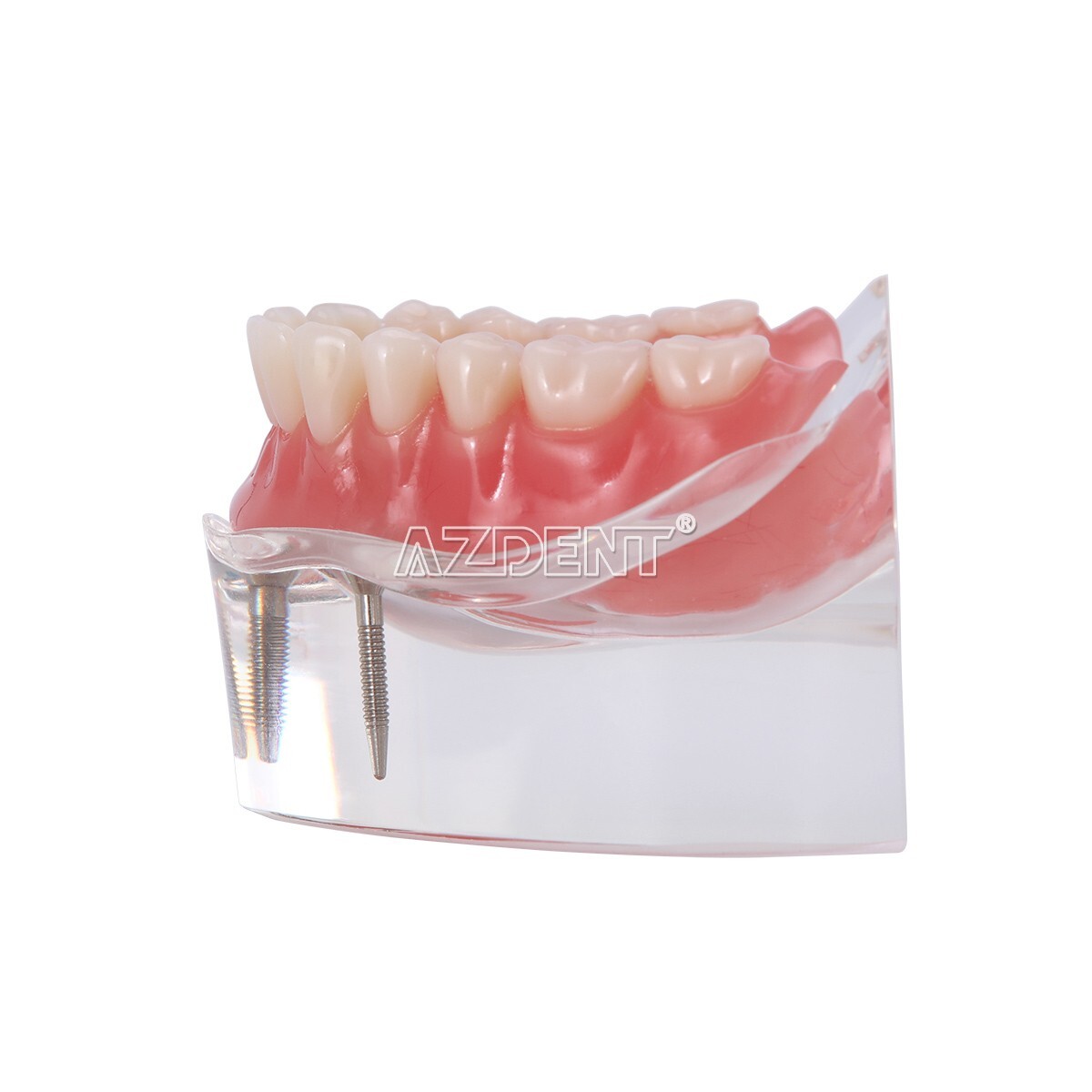 Dental Implant Teeth Model Demo Overdenture Restoration With Implants Lower