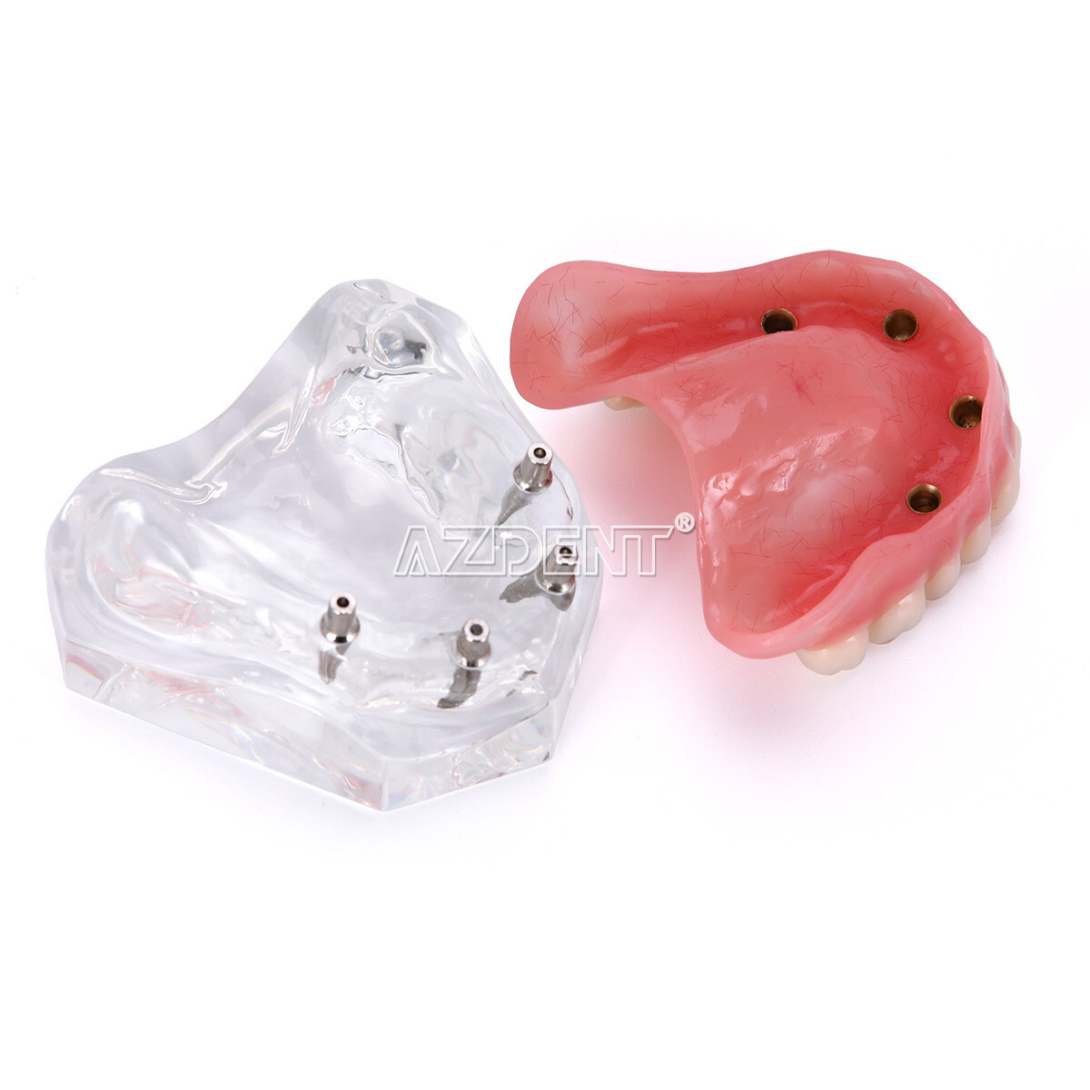Dental Overdenture Implant Teeth Model Denture with implant Demonstration Clear