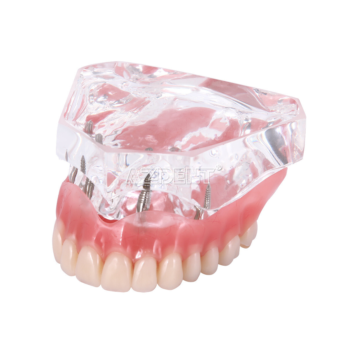 Dental Overdenture Implant Teeth Model Denture with implant Demonstration Clear