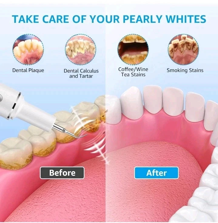 Ultrasonic Tooth Cleaner Tartar Plaque Remover Electric Dental Whiten Kit Scaler