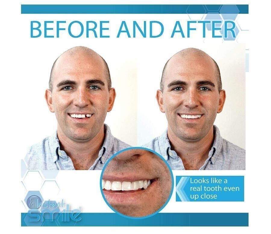 Instant Smile Multi-Shade Temporary Tooth Repair Kit 3 SHADES-Rapid Repair