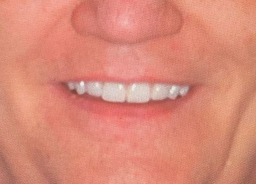 DLP SLA LCD 3d printer ALL ON X resin - for all on x cases, bridges,arcs, hybrid