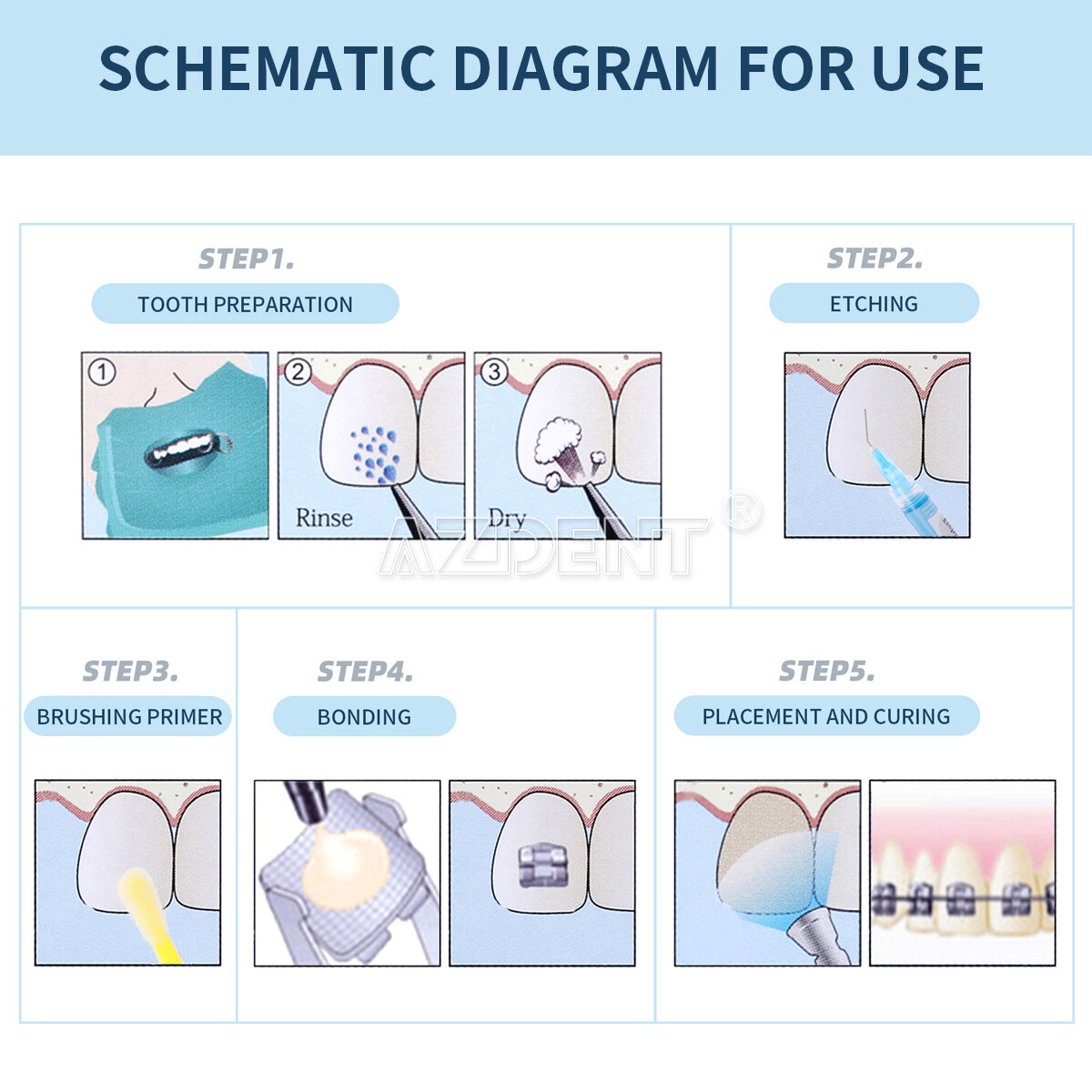 Dental Glue Ortho Bonding System Light Cure Primer Adhesive Kit For Brackets