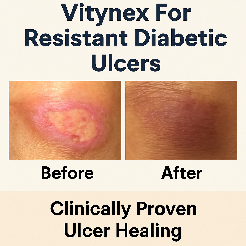 Vitynex™ Bed Sore & Diabetic Ulcer, Wound Care Cream for 4X Fast Healing