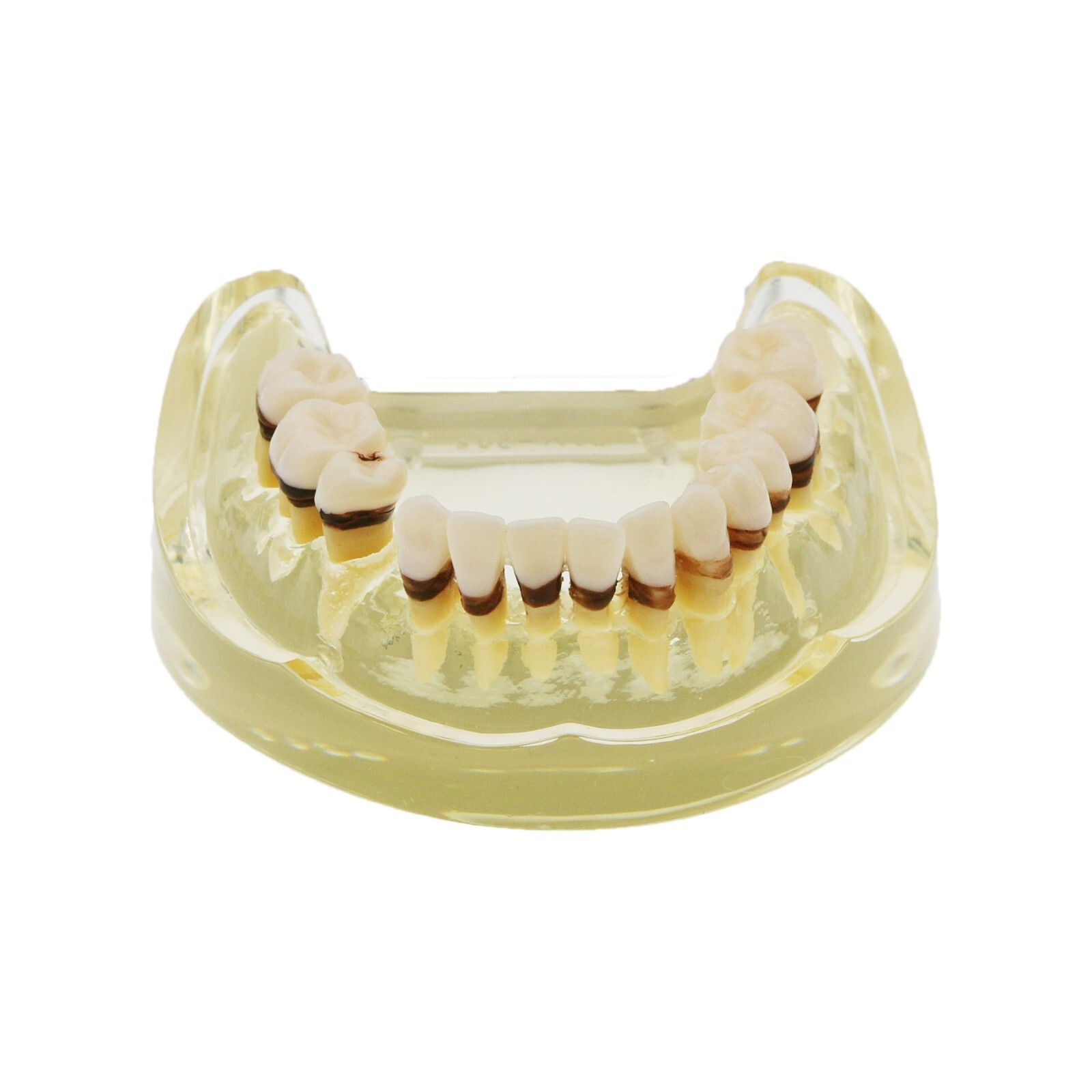 Dental Adult Periodontal Disease Pathological Teeth Typodont Model Removable Gum