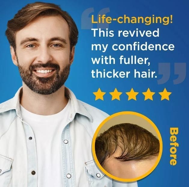 Kirkland Minoxidil 5% for Men & Women UniversalSolution for Pattern Baldness & T