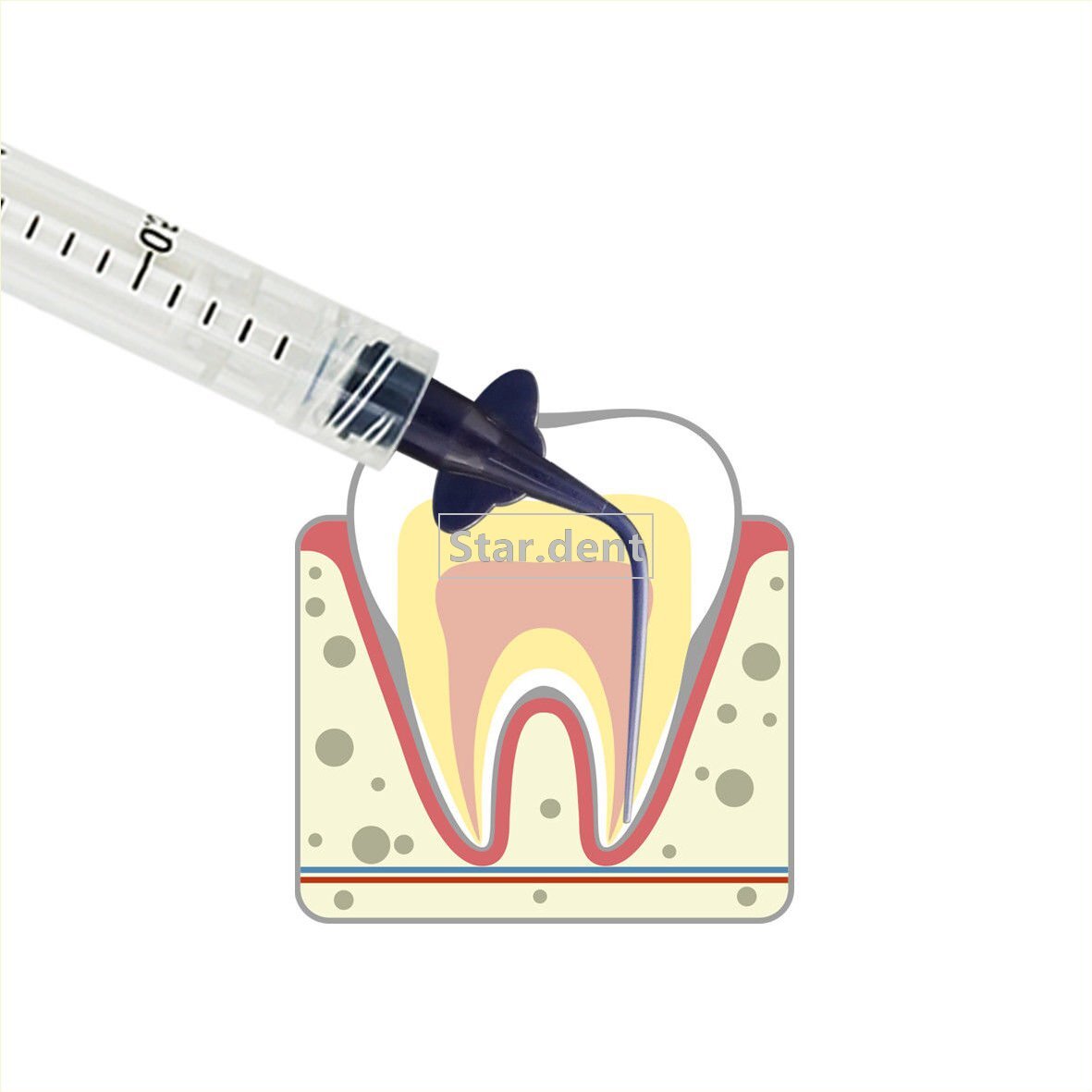 Dental Root Canal Endo Irrigation tip Prebent Syringe Tips Needle 0.25/0.35mm