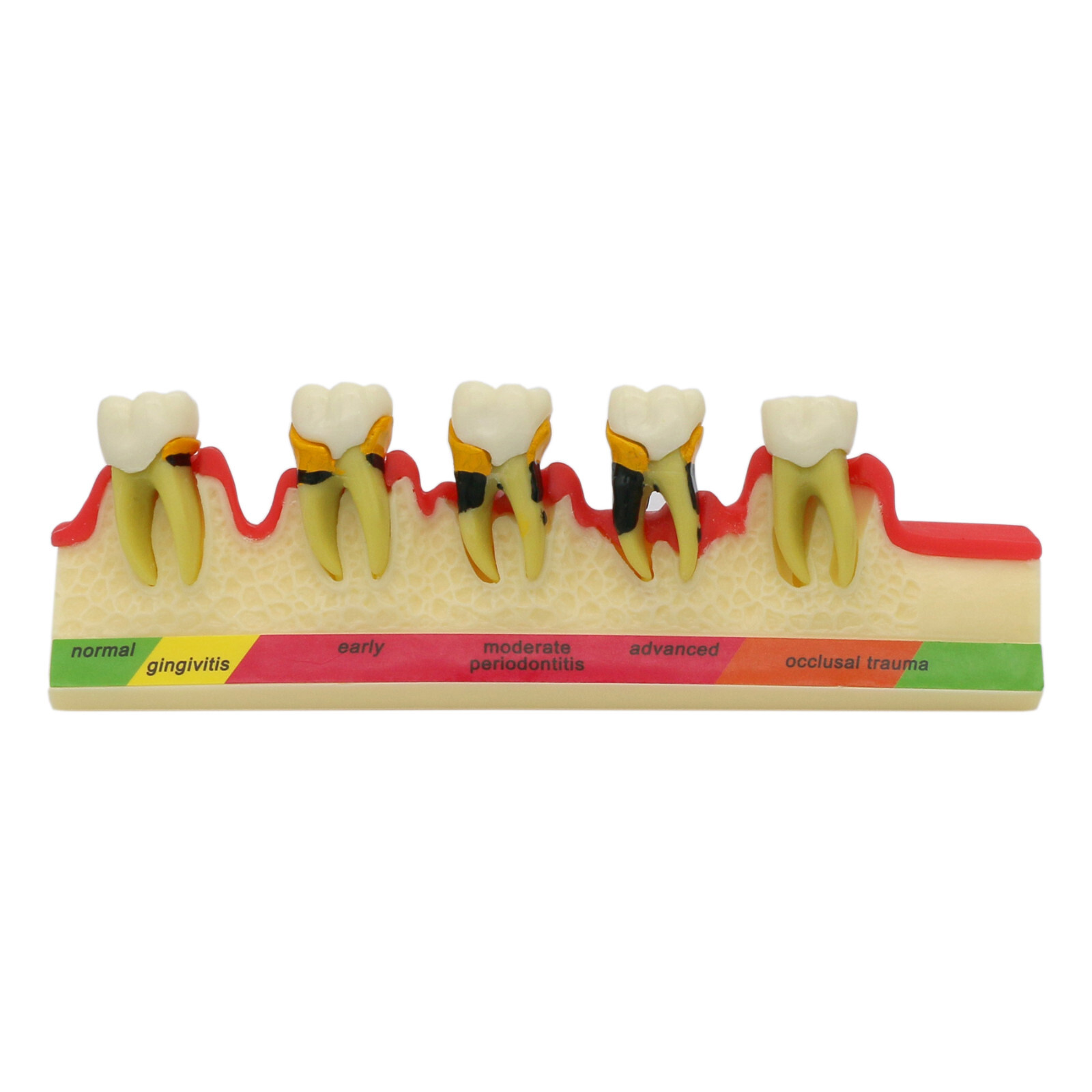 Dental Teeth Model Pathological Typodont Periodontics Endo Disease Assort Demo