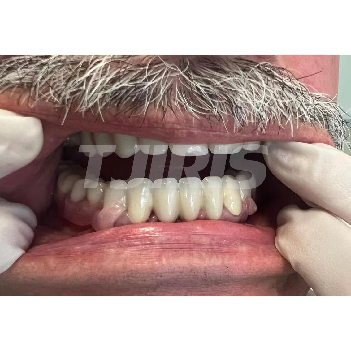 Dental Flexible Partial Denture 3D Printing Resin for 405nm or 385nm Printer