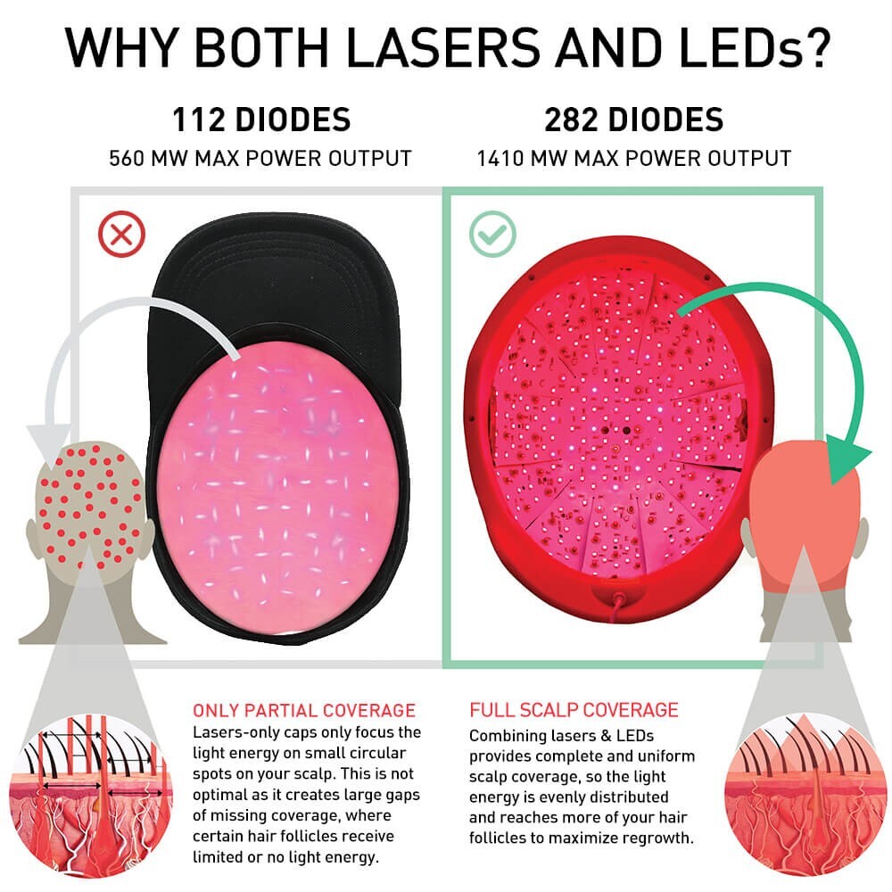 iRESTORE Professional 282 Laser Hair Growth System - Reconditioned