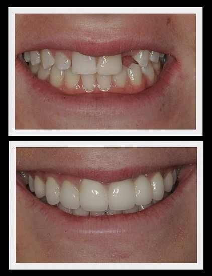 TEMPORARY TOOTH REPAIR or REPLACE KIT DIY makes 25-30 teeth *No Adhesive needed*