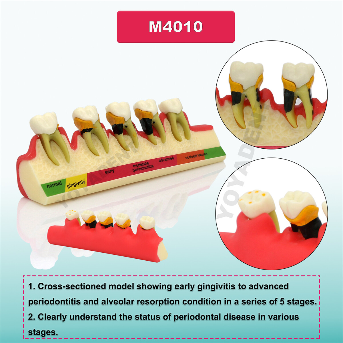 Dental Model Periodontal Disease Assort Teeth Model Endodontic Teaching Demo US