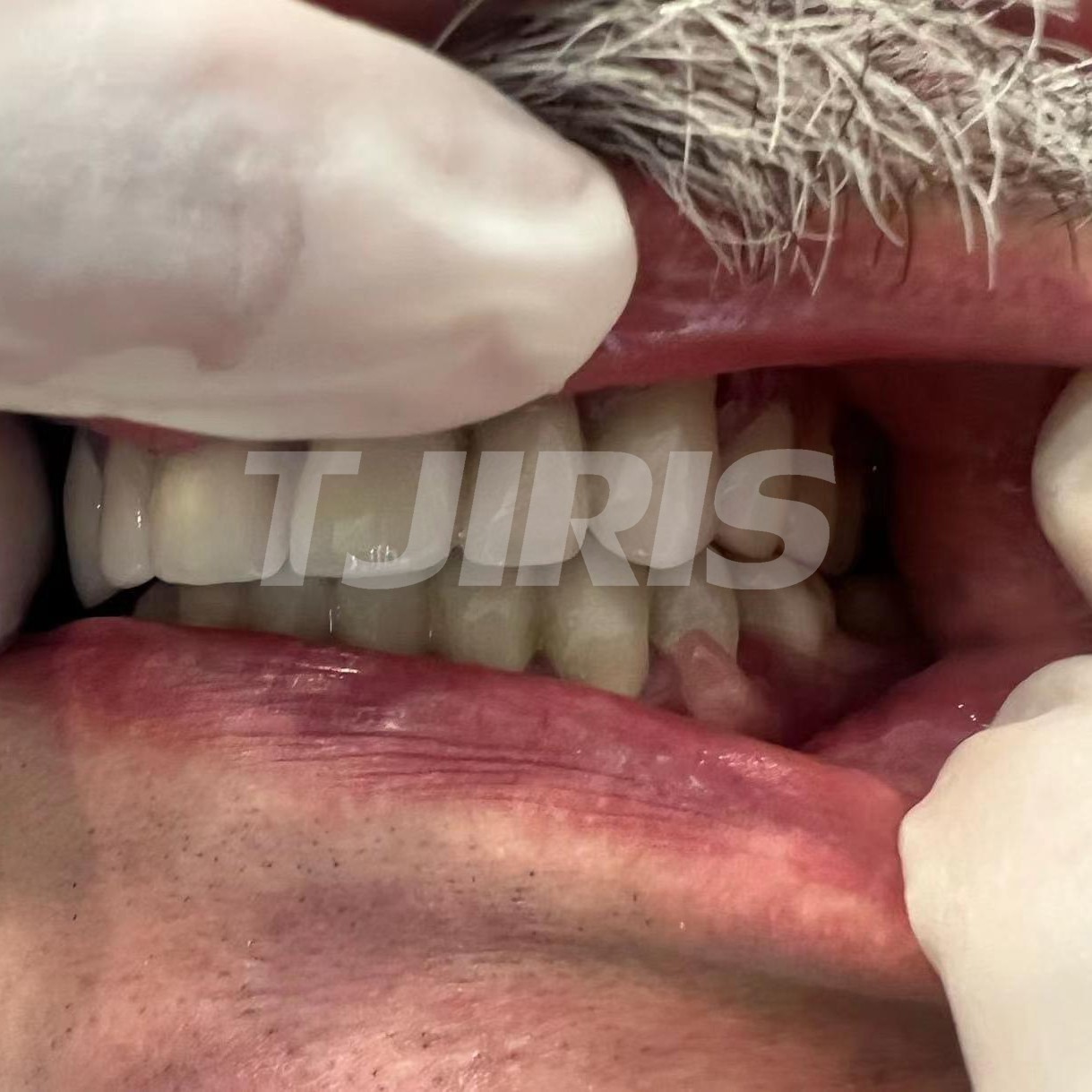 Dental Flexible Partial Denture 3D Printing Resin for 405nm or 385nm Printer