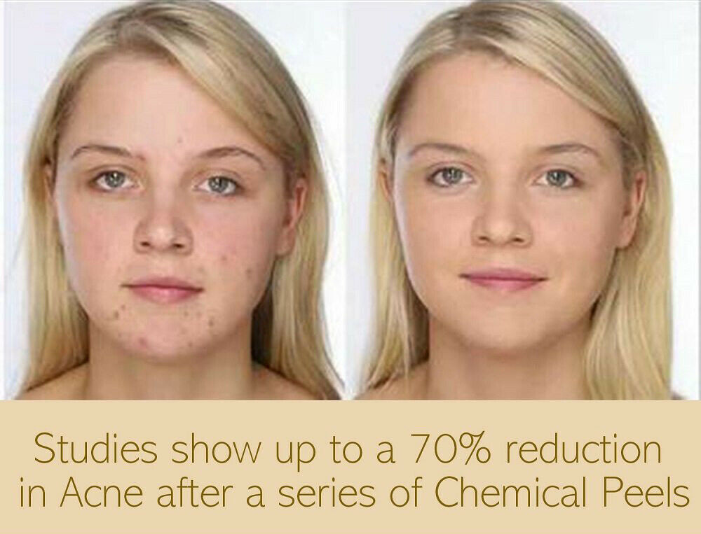 Lactic Acid Skin Peel For Acne Wrinkles Melasma Age Spots 25% 40% 50% 90%