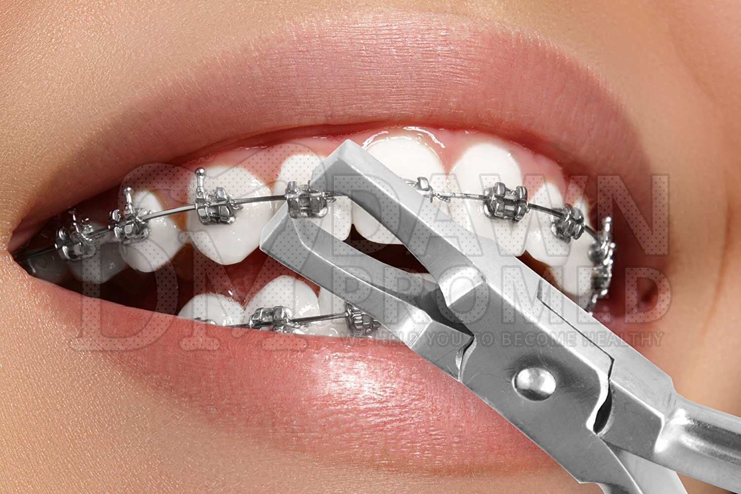 Orthodontic Pliers Braces Remover Tools Bracket Gripper Plier Dental German Gr