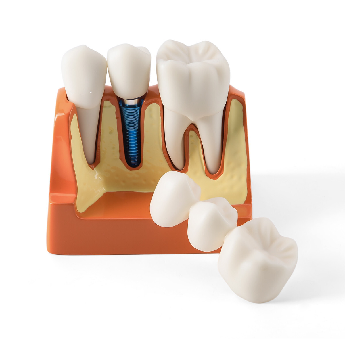 4 Times Dental Teeth Removable Model Implant Teaching Learning Tool Analysis