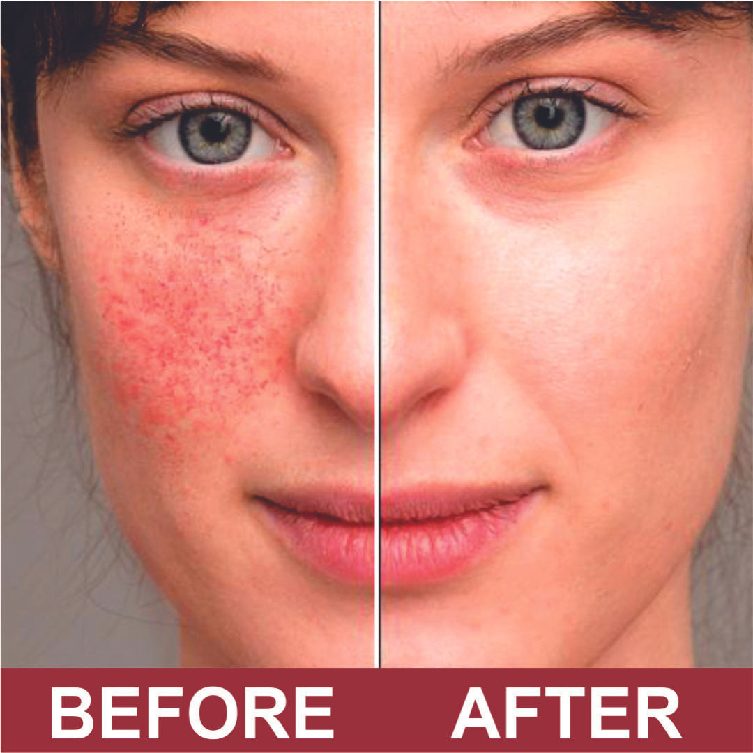 Quatriderm* Crema NF 1% Hydrocortisone - Anti-Itch Cream With Aloe Vera