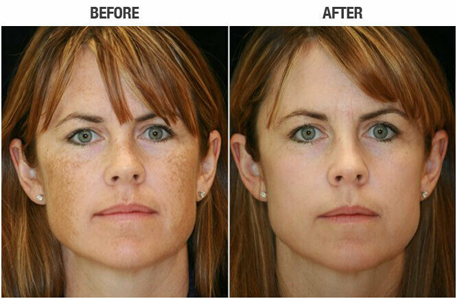 Lactic Acid Skin Peel For Acne Wrinkles Melasma Age Spots 25% 40% 50% 90%