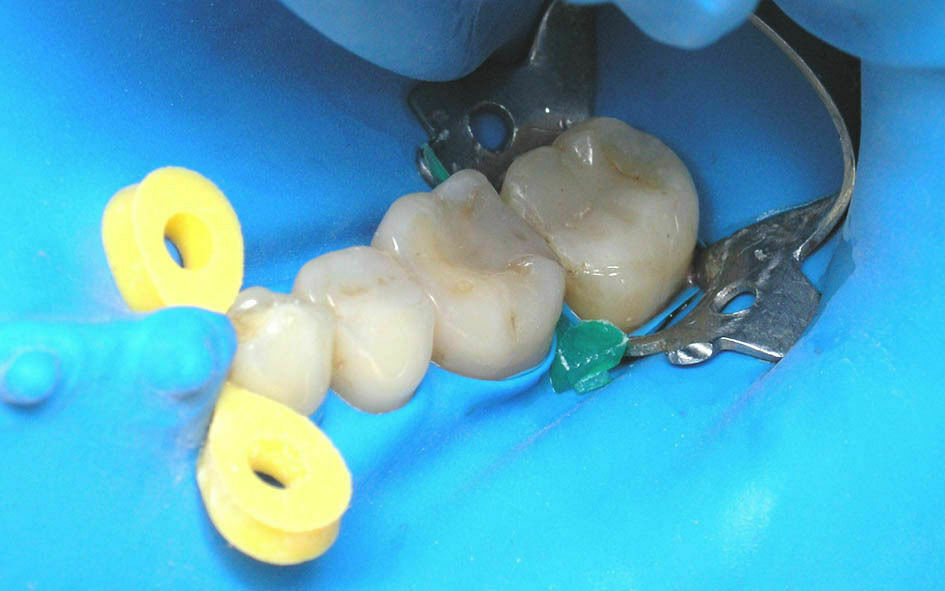 Dental Elastic Fixing Wedges Composite Soft & Hard Matrix Matrices Rubber Dam