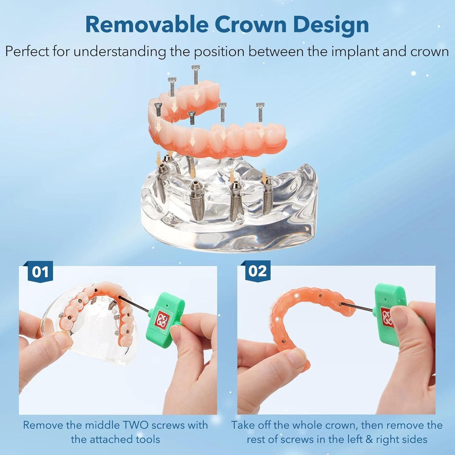 Dental Implant Restoration Model Upper Jaw 6 Screws Post Core Bridges M6001-2 US