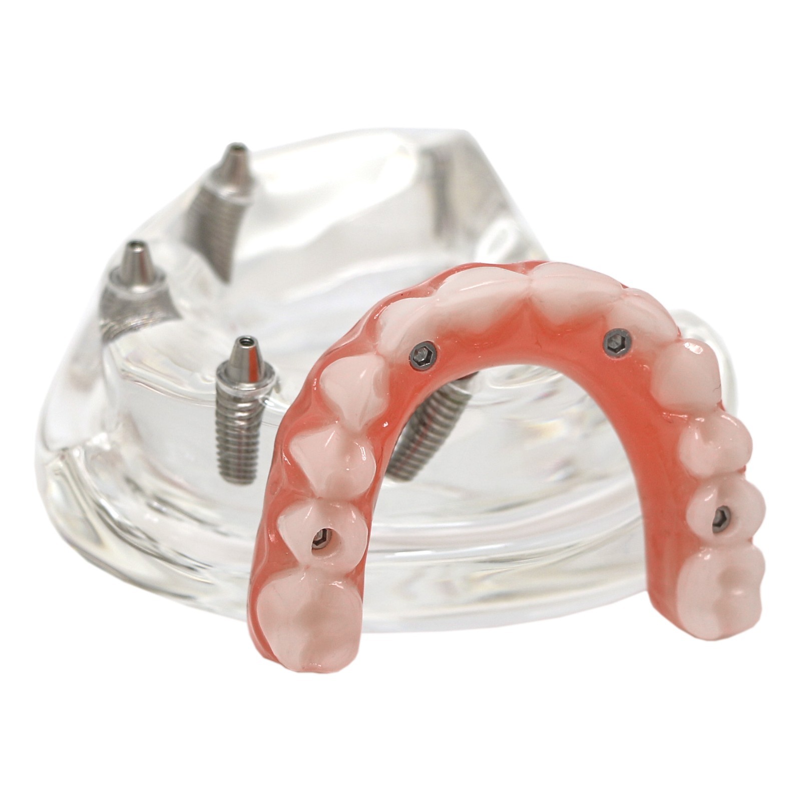 Implant Overdenture Al-on-4 treatment concept Demo Teeth Model Upper/4Srew Clear