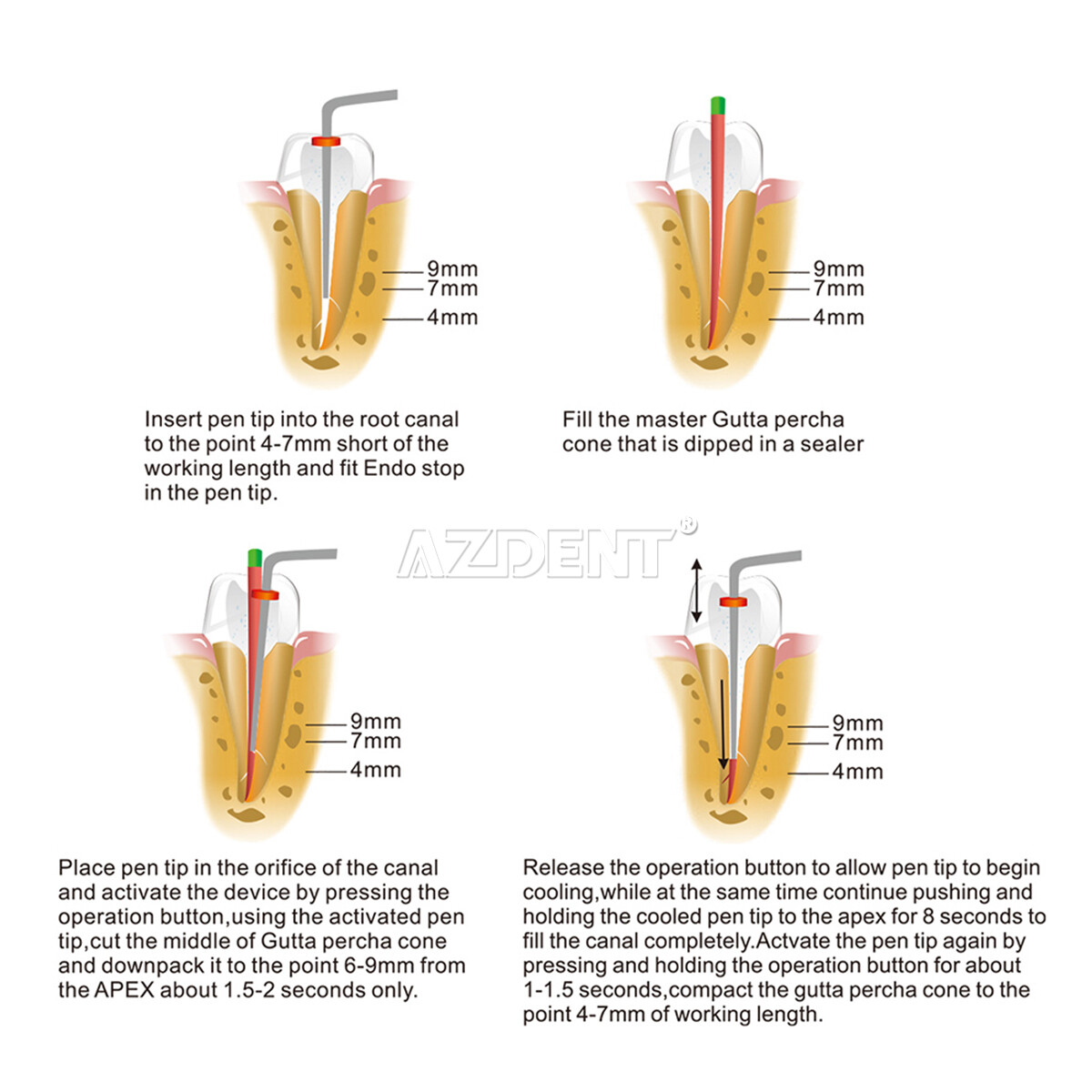 Sistema de obturación endodoncia dental pluma calentada/cortador de gutapercha