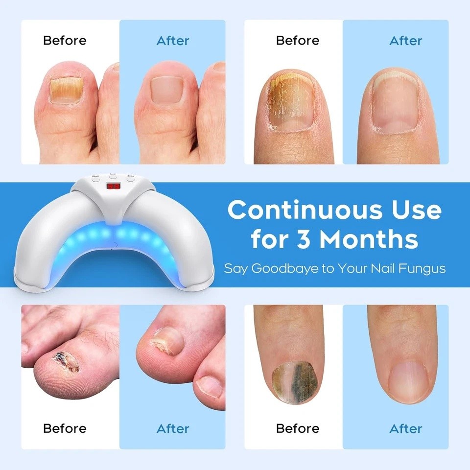 Nail Fungus Laser Nail Fungus Cleaning LED Light Device for Multiple Toenail US