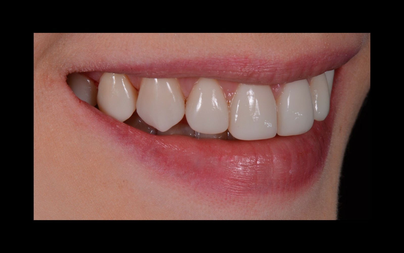 DLP SLA LCD 3d printer permenant crown - teeth resin ..