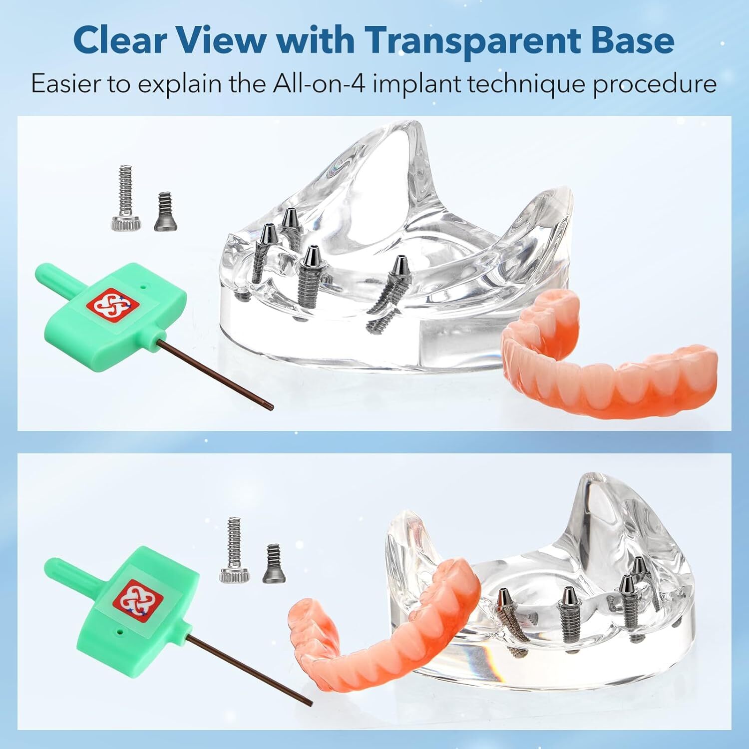 Dental Implant All-on-4 Overdenture Treatment Model Upper/Lower 4 Implants Clear