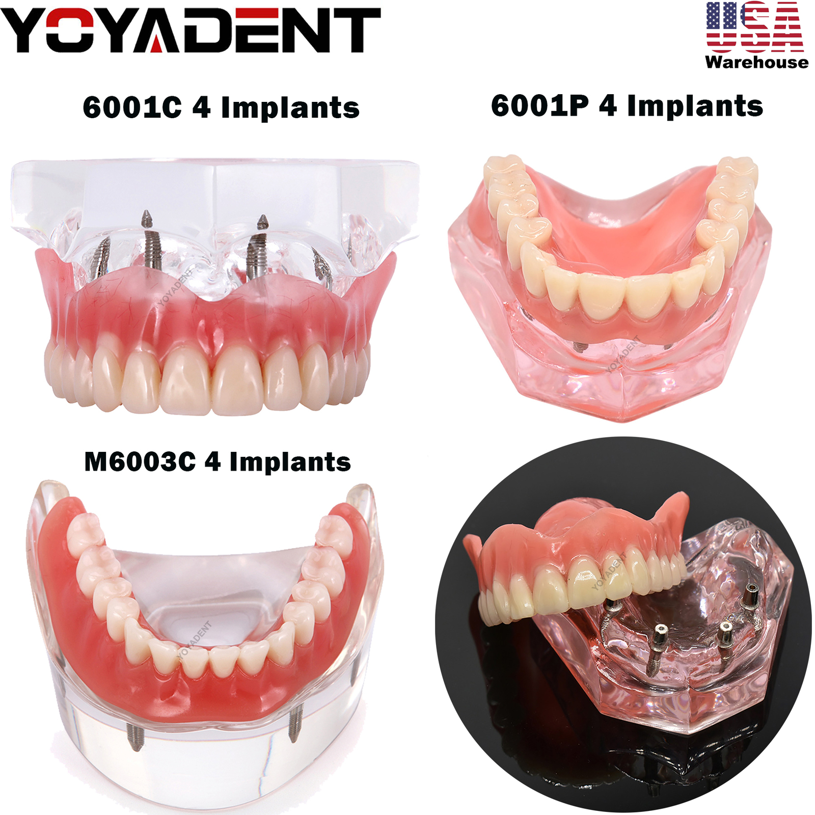 Dental Implant Teeth Demo Overdenture Restoration With 4 Implants Upper/Lower US