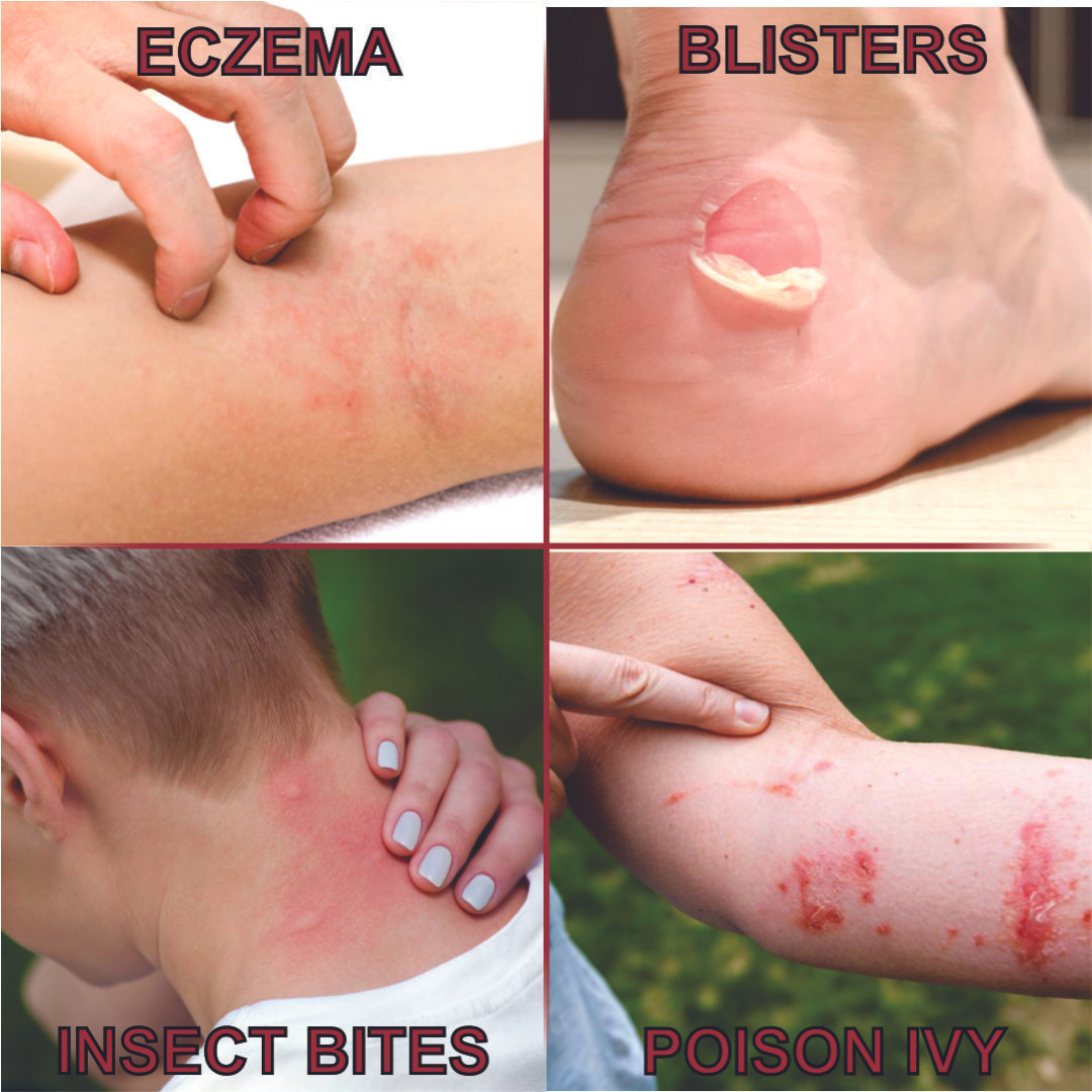 Quatriderm* Crema NF 1% Hydrocortisone - Anti-Itch Cream With Aloe Vera