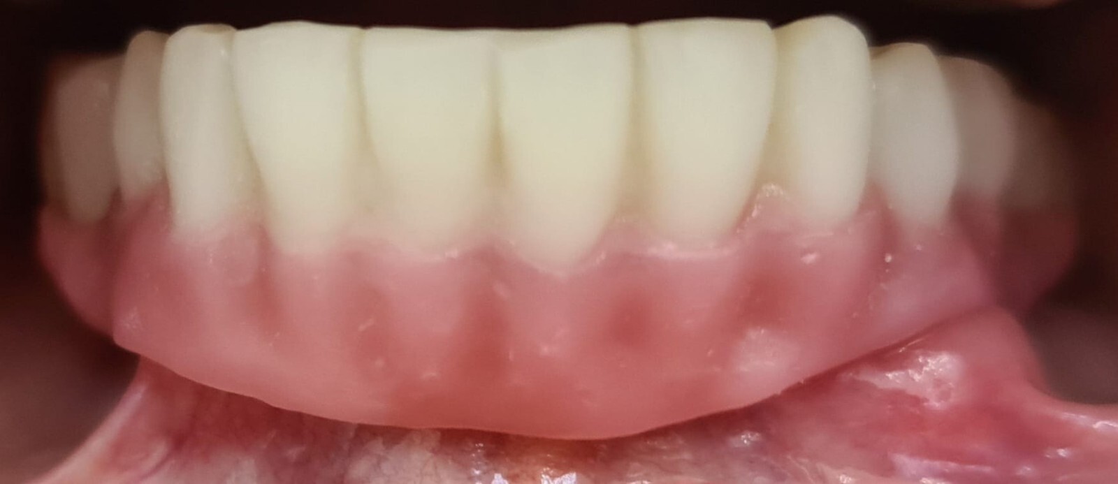 DLP SLA LCD 3d printer ALL ON X resin - for all on x cases, bridges,arcs, hybrid