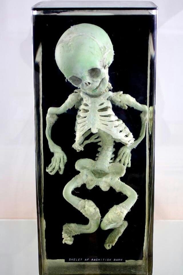 12 Week Fetus/Fetal Skeleton Curvature of Limbs Oddity Curiosity Sideshow Gaff