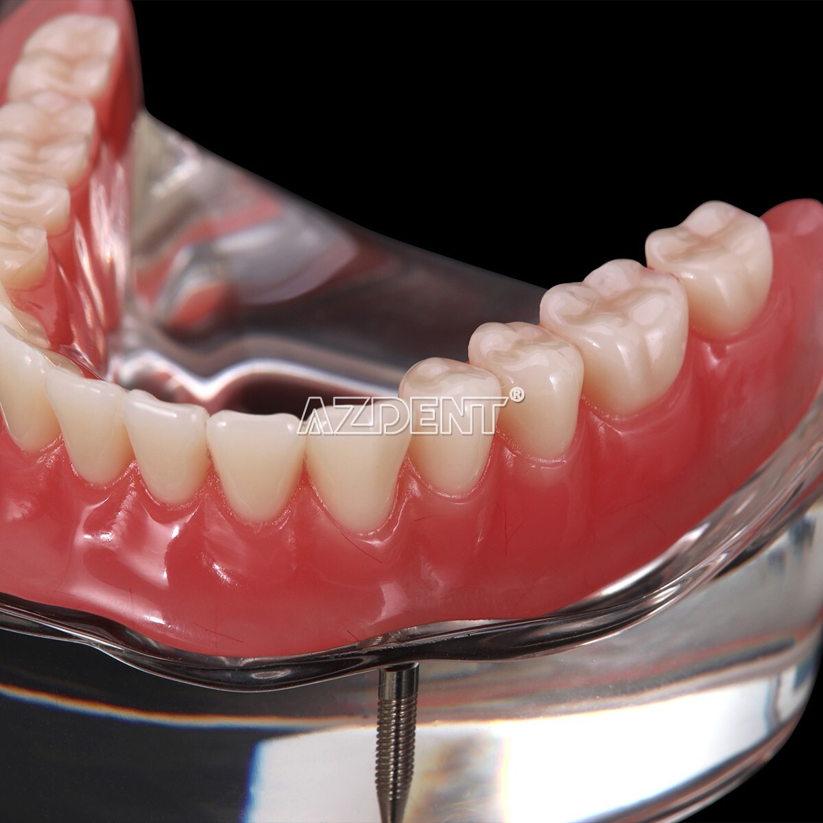 Dental Implant Teeth Model Demo Overdenture Restoration With Implants Lower