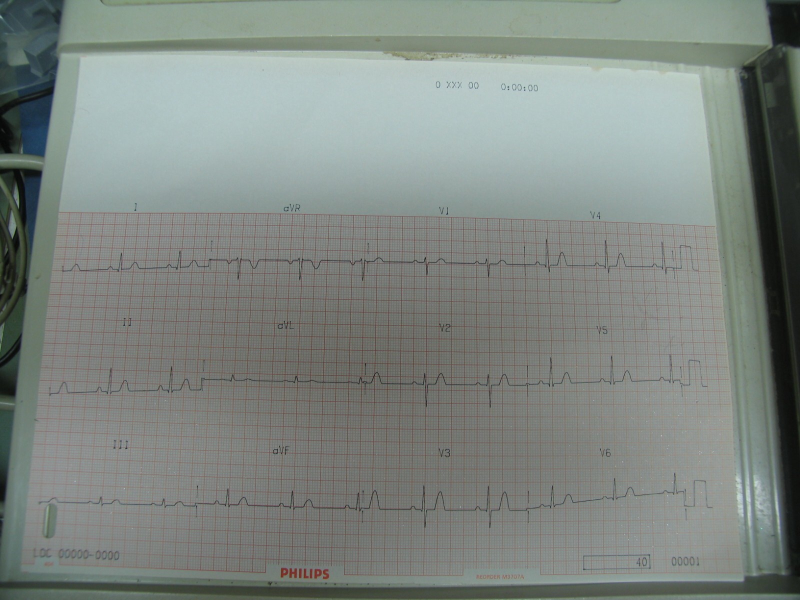 HEWLETT PACKARD (HP) PAGEWRITER II 4755A NON-INTERPATIVE EKG TESTED AND WORKING