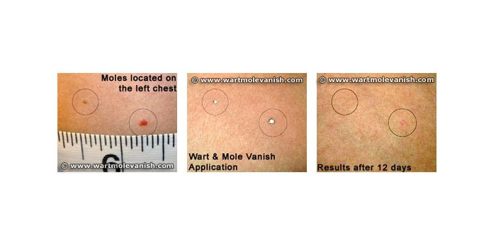 Mole Remover, Wart Remover, Skin Tag remover, Wart Mole Vanish™ Award Winning