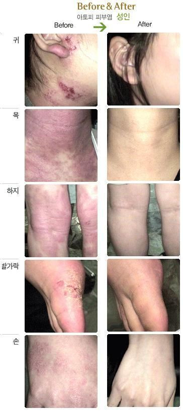 One ISAL Atopy Eczema Cream Lotion./Made in USA