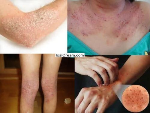 One ISAL Atopy Eczema Cream Lotion./Made in USA