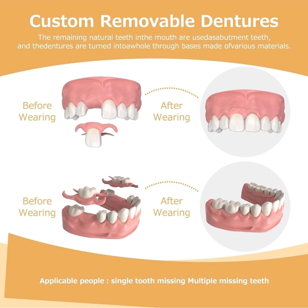 Partial Dentures - Dentures for Missing Teeth & Gaps - Lightweight & Unbreaka...