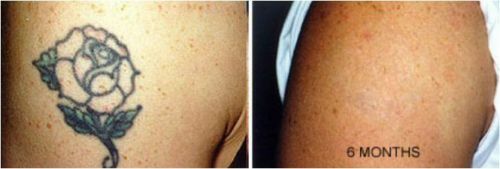 Tattoo Removal Cream Natural Fading system wrecking balm