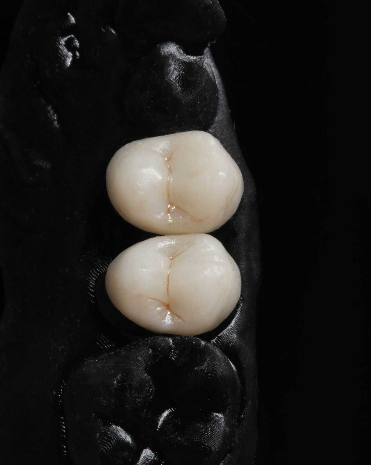 DLP SLA LCD 3d printer permenant crown - teeth resin ..